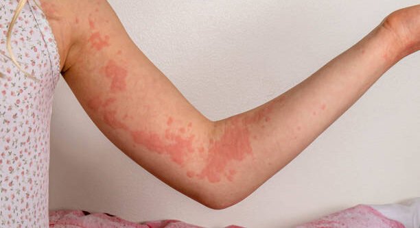 Skin Allergies in Ayurveda: Causes, Symptoms & Natural Remedies